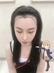 -大麦微针植发丨全国连锁