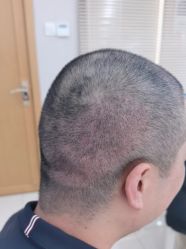 -大麦微针植发丨全国连锁