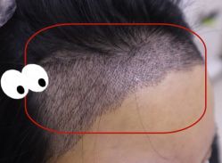 -大麦微针植发全国连锁