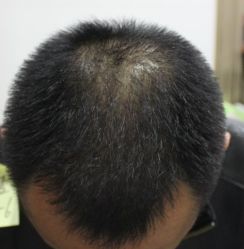 -大麦微针植发丨全国连锁
