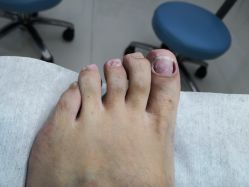 -派恩宜灰指甲鸡眼嵌甲手足癣