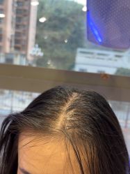 -碧莲盛·不剃发植发