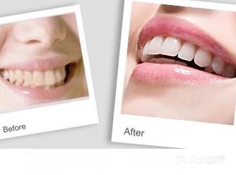 做完牙齿贴面会变色吗？