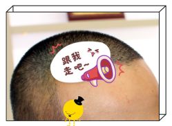 -大麦微针植发全国连锁