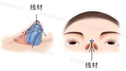 -北京米扬丽格医疗美容·联合丽格鼻整形中心