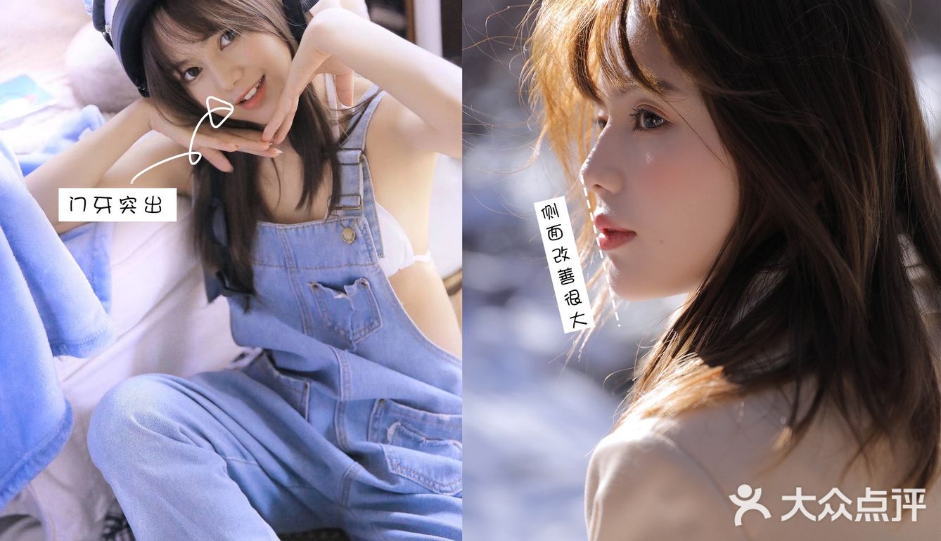 牙齿矫正案例 虎牙小美女逆袭日记