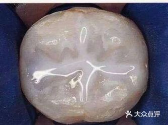 听说，窝沟封闭也能防龋？