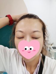 体验后-More摩尔医美の注射线雕光电中心