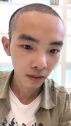 点击看大图 -大麦微针植发丨全国连锁