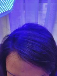 -碧莲盛·不剃发植发