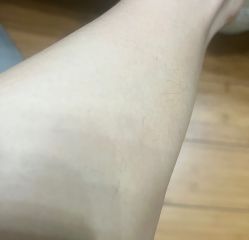 体验后-四川娇点医学美容医院