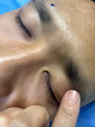 体验前-百年美肤堂祛痦痣祛斑祛疣