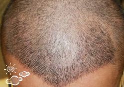 -大麦微针植发丨全国连锁