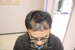 -大麦微针植发丨全国连锁