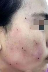 -北京美痣堂古方祛痣斑疣瘊