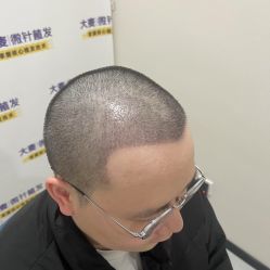 -大麦微针植发全国连锁