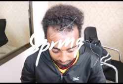 体验前-大麦微针植发全国连锁