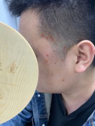 -百年美肤堂祛痦痣祛斑祛疣