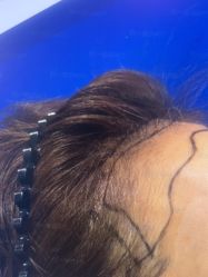 体验前-雍禾植发全国连锁