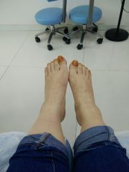 -派恩宜灰指甲鸡眼嵌甲手足癣