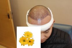 -大麦微针植发丨全国连锁