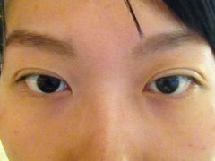 第五天-上海华安整形外科门诊部