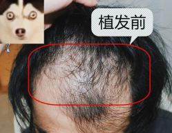 -大麦微针植发全国连锁