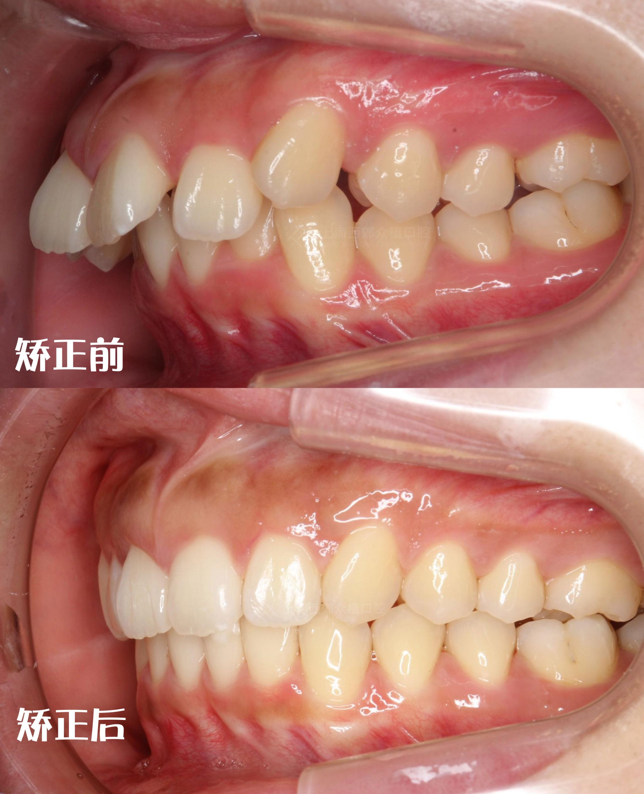 牙套前后对比照凸嘴图片