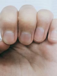 -德哥灰指甲脚气甲沟炎跖疣护理