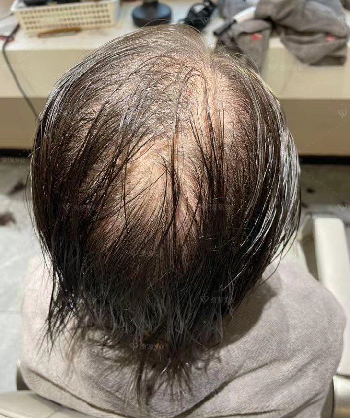 头发太稀疏又想染发怎么办?