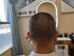 -碧莲盛·不剃发植发