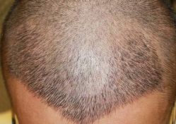 -大麦微针植发全国连锁