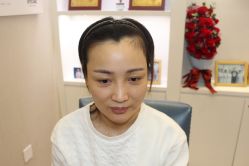 -大麦微针植发丨全国连锁