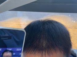 -碧莲盛·不剃发植发