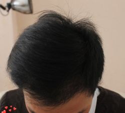 -大麦微针植发丨全国连锁