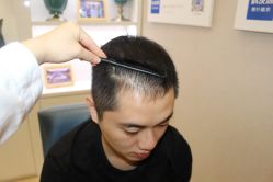 -大麦微针植发丨全国连锁