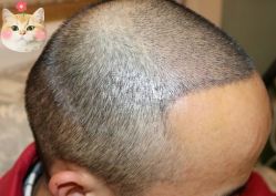 -大麦微针植发丨全国连锁