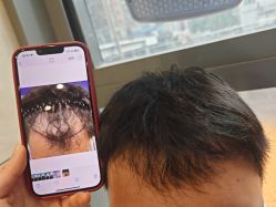 -碧莲盛·不剃发植发