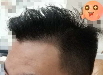 -大麦微针植发丨全国连锁