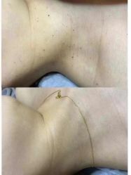 -爱莎扁平疣·汗管瘤·斑痣中心