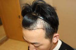 -大麦微针植发丨全国连锁