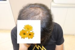 -大麦微针植发丨全国连锁