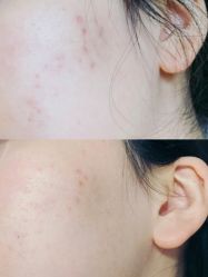 -苗方清颜痘肌研究所