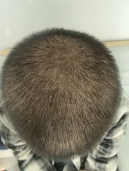 -大麦微针植发丨全国连锁