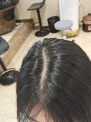 -碧莲盛·不剃发植发