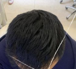 -大麦微针植发丨全国连锁