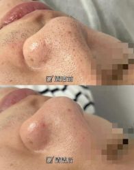 -苗方清颜专业祛痘