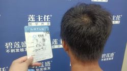 -碧莲盛·不剃发植发