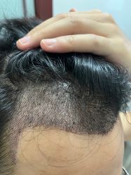 -大麦微针植发全国连锁