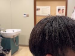 -碧莲盛·不剃发植发